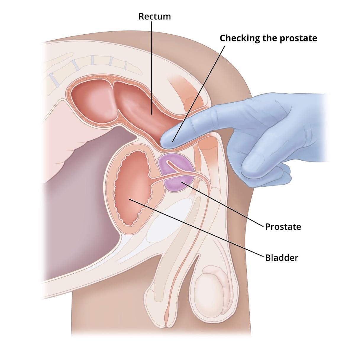 How Prostate ‍Cancer Detection Technology is Revolutionizing Patient Care